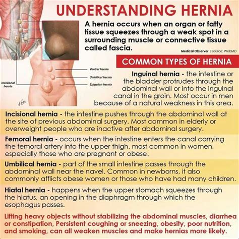 inguinal hernia patient handout pdf